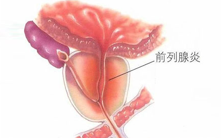 前列腺炎导致的早泄怎么治疗？