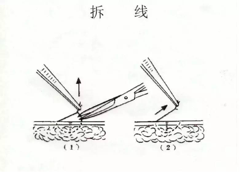 科普：割包皮的八大真相!