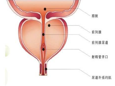 慢性非细菌性前列腺炎的诱发因素