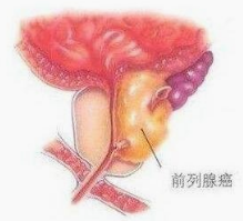 实用养生操为男人防治前列腺病