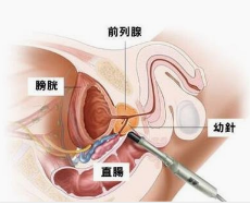 慢性前列腺炎对生育有影响吗?